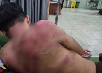 Diduga Dianiaya Oknum TNI di Makodim 0420/Sarko, Warga Merangin Alami Luka Lebam dan Jalani Perawatan Intensif