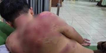 Diduga Dianiaya Oknum TNI di Makodim 0420/Sarko, Warga Merangin Alami Luka Lebam dan Jalani Perawatan Intensif