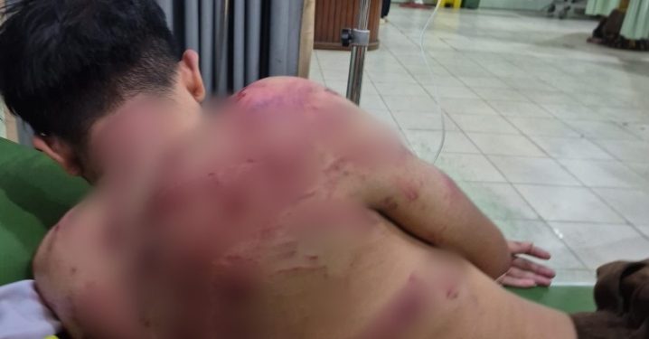 Diduga Dianiaya Oknum TNI di Makodim 0420/Sarko, Warga Merangin Alami Luka Lebam dan Jalani Perawatan Intensif